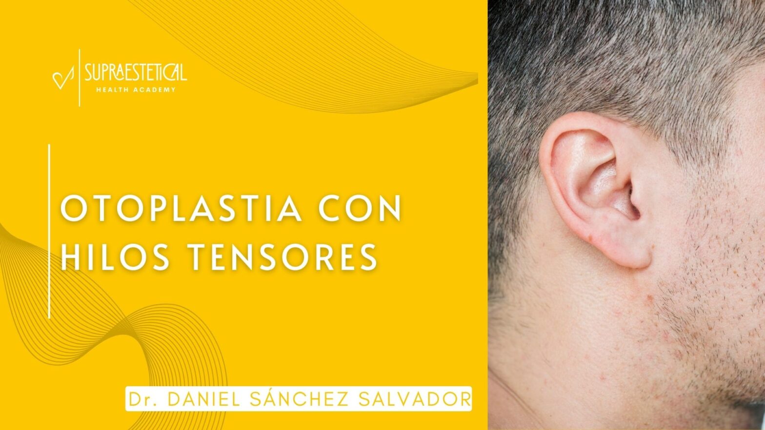 Otoplastia con hilos tensores